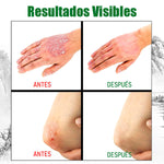 2x1 | Crema Antifúngica y Antipicazón – Tratamiento Natural para Tiña, Hongos y Psoriasis