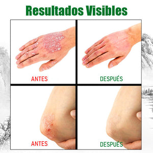 2x1 | Crema Antifúngica y Antipicazón – Tratamiento Natural para Tiña, Hongos y Psoriasis